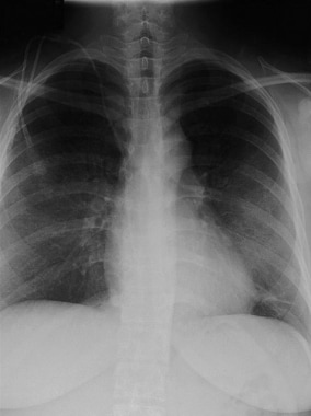 Noncardiogenic pulmonary edema following exposure 