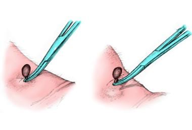 To remove a tick, use fine-tipped forceps and wear
