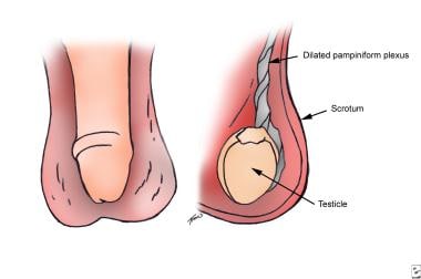 Male infertility. Varicocele. A - Physical examina