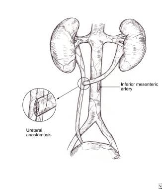 Stent Nephrostomy Ureteral Urology Pu Disposables Placement Ptfe ...