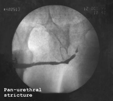 Retrograde urethrogram demonstrating pan-urethral 