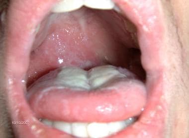 Right peritonsillar abscess. The soft palate, whic