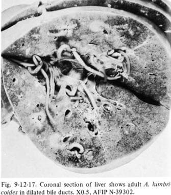 Adult Ascaris lumbricoides in biliary system. 