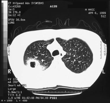 Empyema and Abscess Pneumonia. A 42-year-old man d