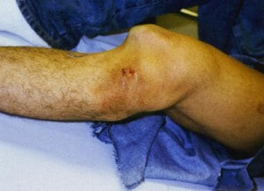 Lateral knee dislocation (before reduction). 