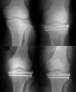 Type II tibial plateau fracture in a young active 