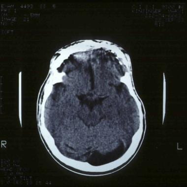 CT scan axial view of a frontal lobe contusion aft