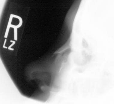 Lateral radiographic view of a displaced nasal bon