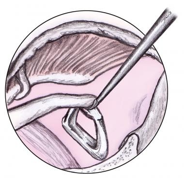 Stapedotomy Animation to Treat Otosclerosis (Curable Type of