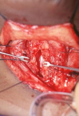 An intraoperative view of a split cricoid in a pat