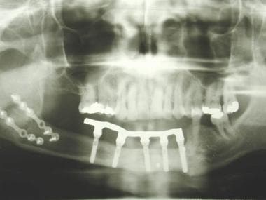 Patient with osseointegrated implants in flap. 