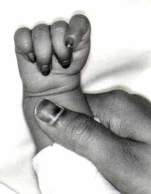 Photograph of the left hand of a 6-month-old infan