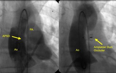 Angiogram of a small-to-moderate aortopulmonary se