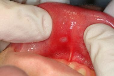 Typical aphthous ulcer in a common site, showing i