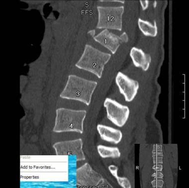 Computed tomography scan of the dorso-lumbar spine showing no fracture