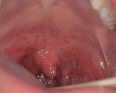 streptococcal pharyngitis rash