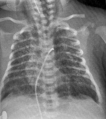 Pneumomediastinum from gas trapping and air leak. 