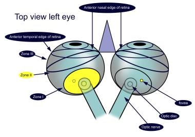 Retinopathy of Prematurity. Zone I retinopathy of 