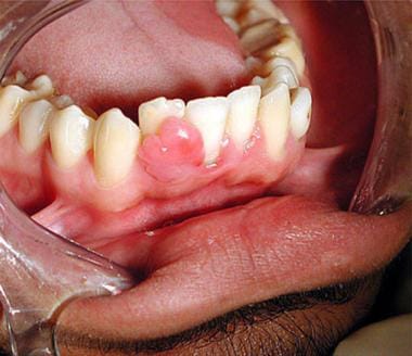 Peripheral odontogenic fibroma of the mandibular g