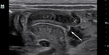 pyloric stenosis shoulder sign