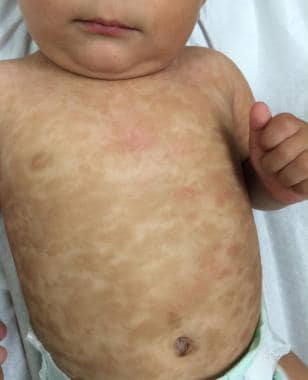 Urticaria pigmentosa on a child.