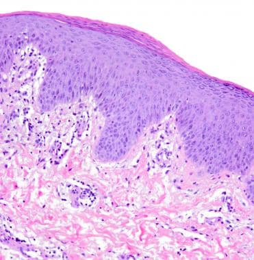 guttate psoriasis