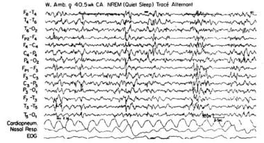 Quiet sleep non–rapid eye movement tracé alternant