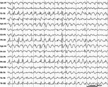 Slow spike-and-wave discharges (2.5 Hz). This is a