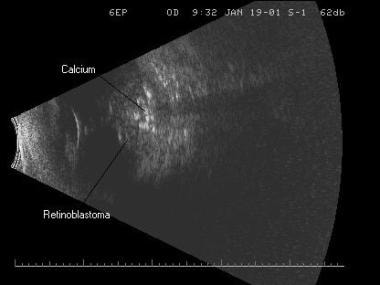 Retinoblastoma. Note the small, highly reflective 