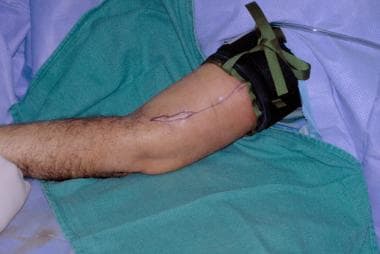 Same patient whose humerus was fractured by a guns
