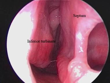Endoscopic view of a septal perforation from the r