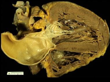 Coronal section with concentric left ventricular h