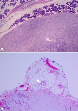 Pathology of Pleomorphic Adenoma. Capsule in pleom