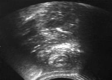 Abdominal ultrasonography reveals the classic targ