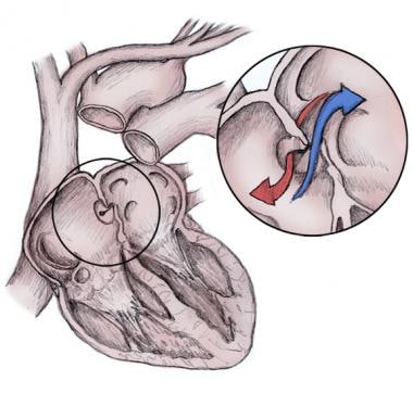 Anatomy of the patent foramen ovale. This figure s