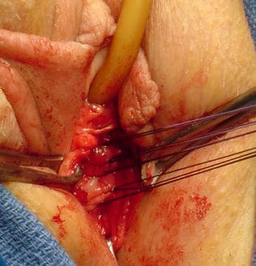 Cystocele Repair