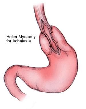 Heller myotomy for achalasia. 
