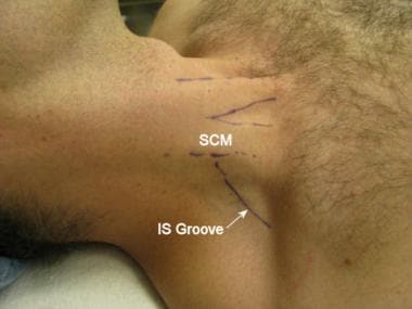 The sternocleidomastoid muscle (SCM) and interscal
