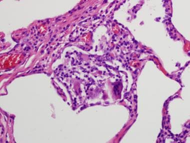 A 46-year-old man with hypersensitivity pneumoniti