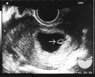 Pregnancy diagnosis. The arrow is pointing to the 