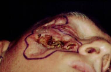 Basal cell carcinoma of the skin. Intraoperative v