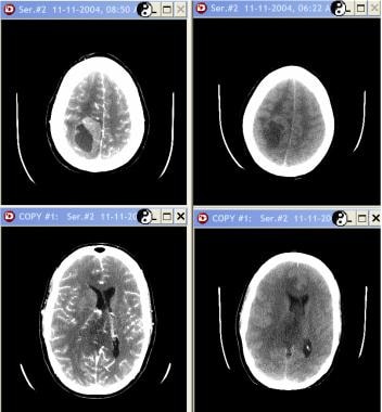 Grade III astrocytoma in a 33-year-old woman. None