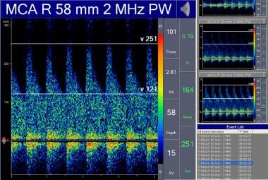 Transcranial Doppler demonstrates pulsatile flow i