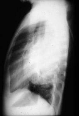This lateral view radiograph of a ganglioneuroblas