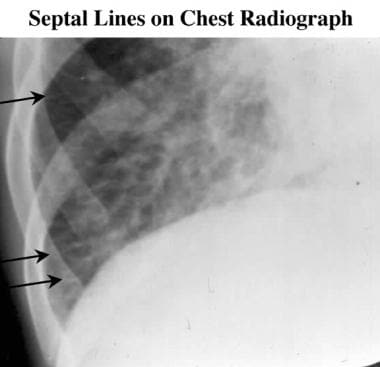 Magnified chest radiograph of the right costophren