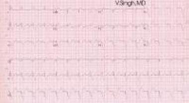 ECG showing biventricular pacing (double ventricul