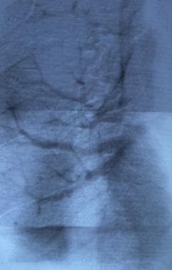 Digital subtraction angiogram shows an arterioveno