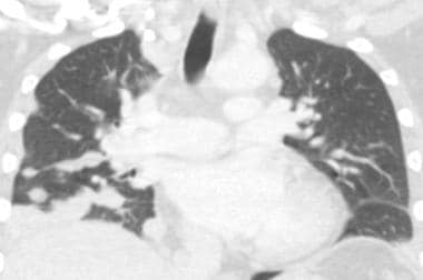 Coronal CT scan of a patient with thyroid cancer s