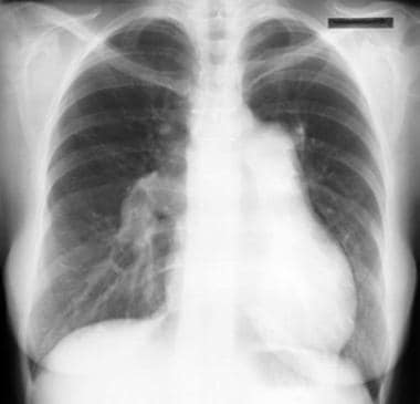 Pulmonary hypertension. Chest radiograph in a pati