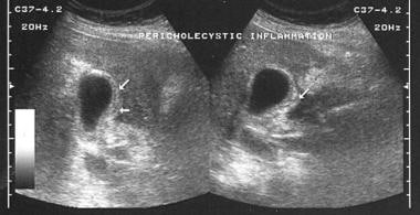 Acute cholecystitis mimic. A 36-year-old woman wit
